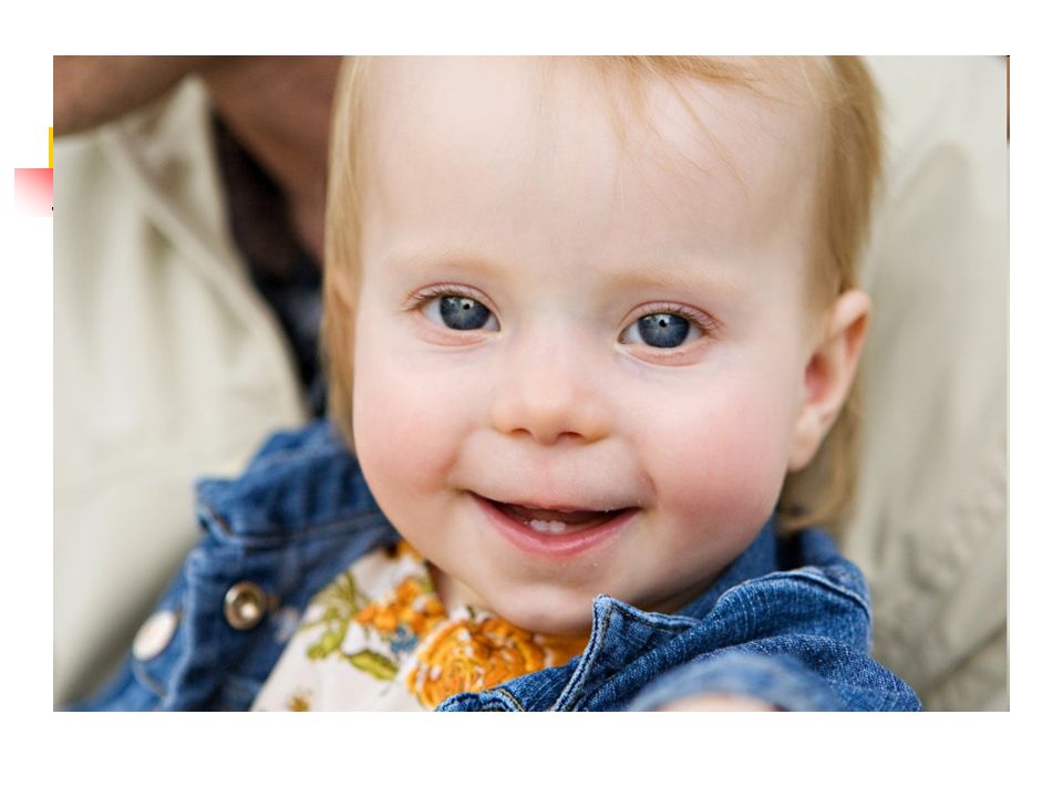 Фенотип ребенка с синдромом дауна. Трисомия 21 мозаичная форма. Мозаичная форма синдрома Дауна.