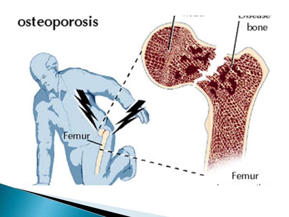 Шейка бедра в пожилом возрасте. Остеопороз у пожилых людей перелом шейки бедра. Причины перелома шейки бедра.