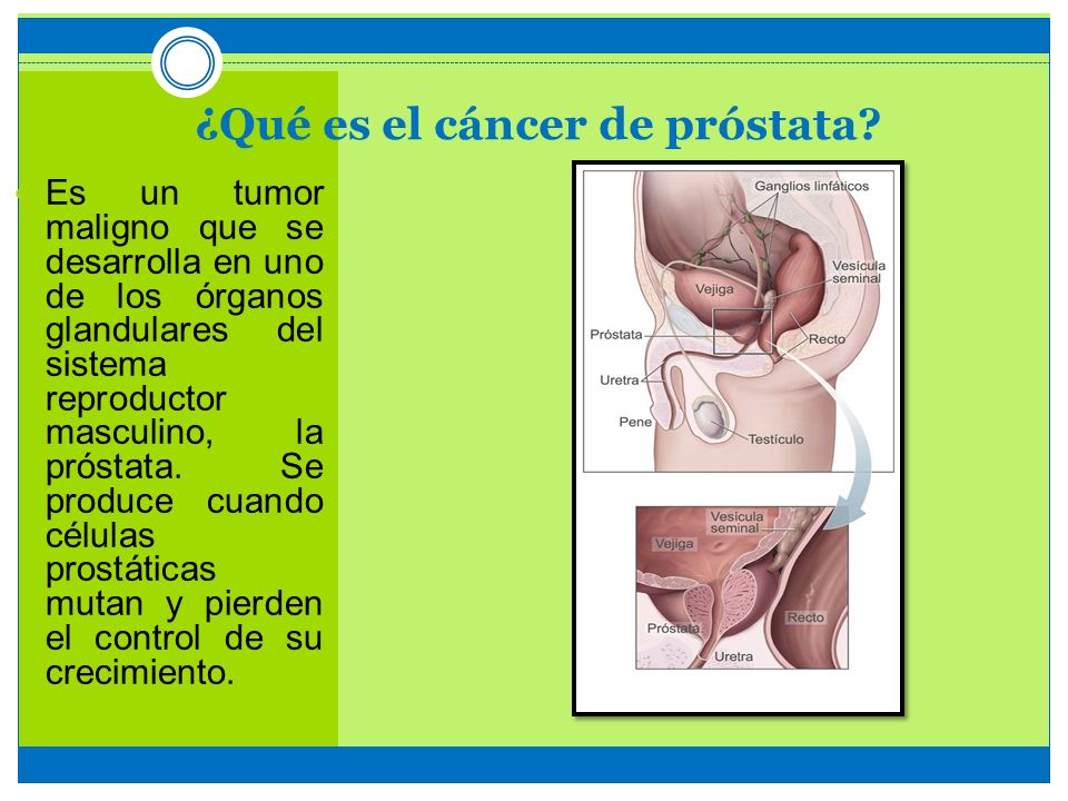 Cancer de prostata oms