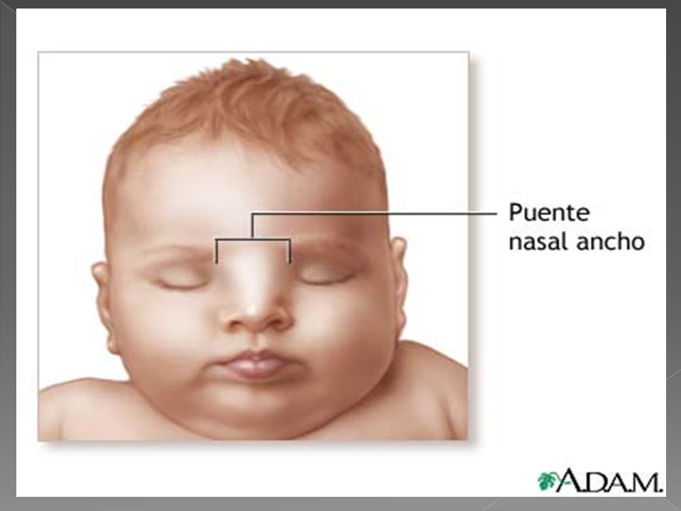 Генетика носа. Плоская переносица у грудничка. Широкая переносица у младенца. Широкая переносица у новорожденных.