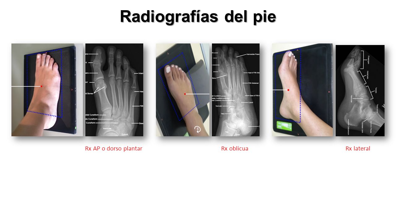 Radiografías del pie Rx AP o dorso plantar Rx oblicuaRx lateral