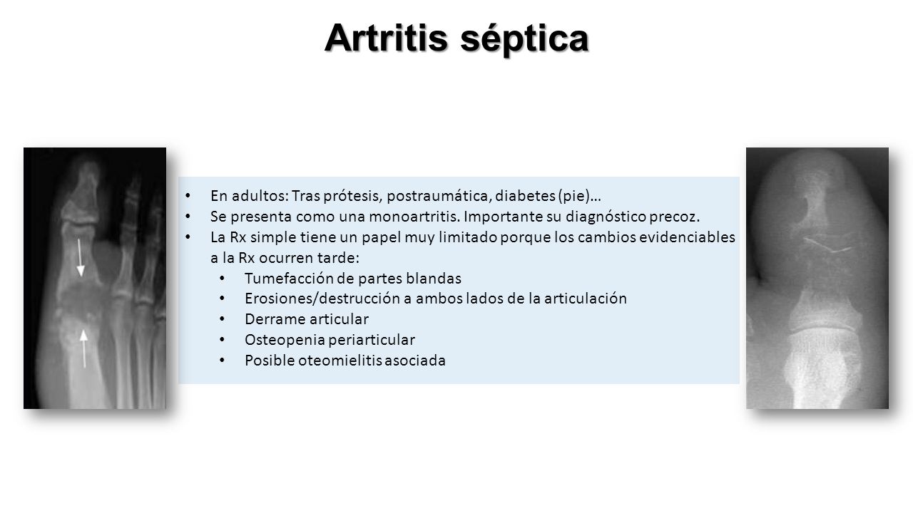 Artritis séptica En adultos: Tras prótesis, postraumática, diabetes (pie)… Se presenta como una monoartritis.