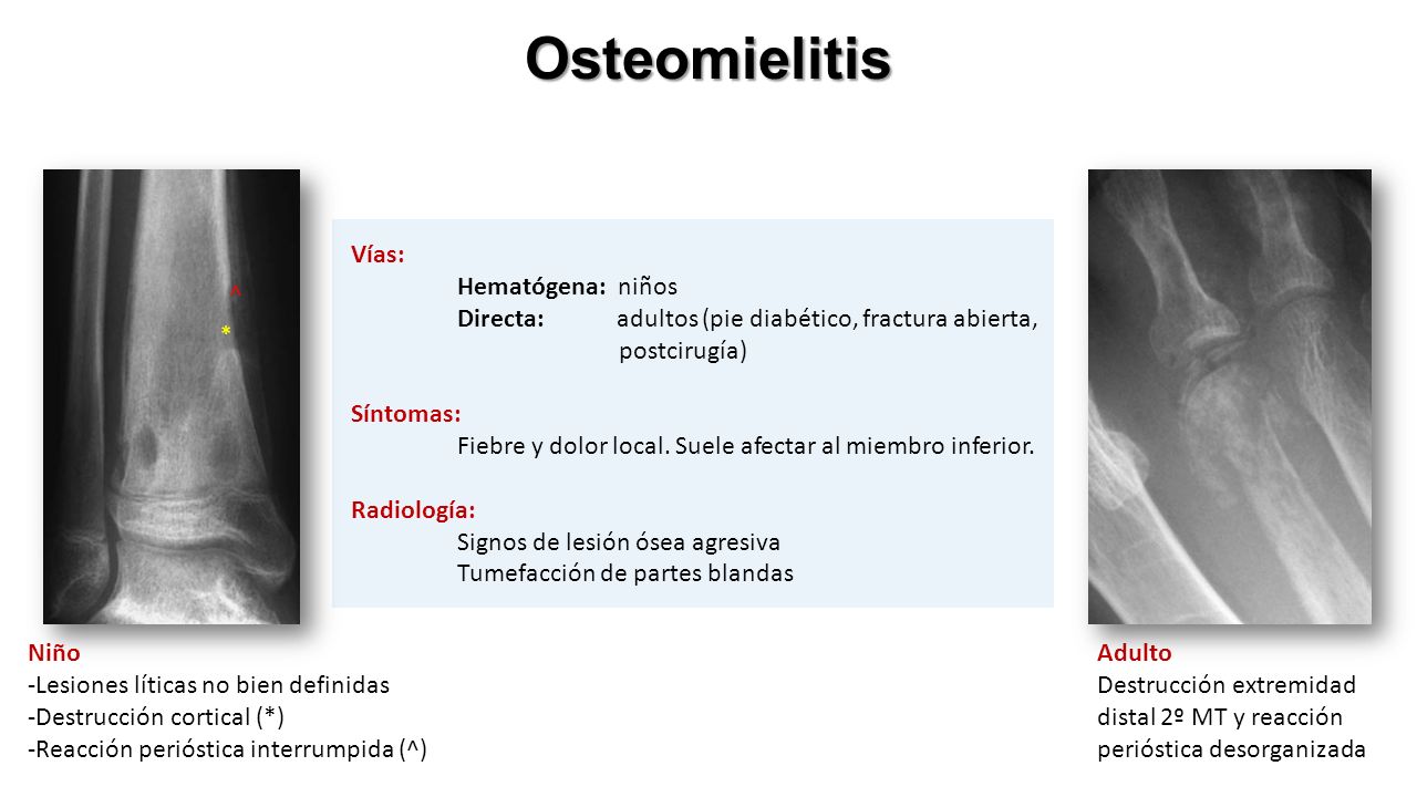 Osteomielitis Vías: Hematógena: niños Directa: adultos (pie diabético, fractura abierta, postcirugía) Síntomas: Fiebre y dolor local.