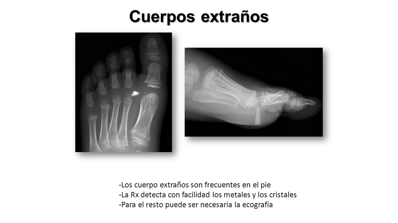 Cuerpos extraños -Los cuerpo extraños son frecuentes en el pie -La Rx detecta con facilidad los metales y los cristales -Para el resto puede ser necesaria la ecografía