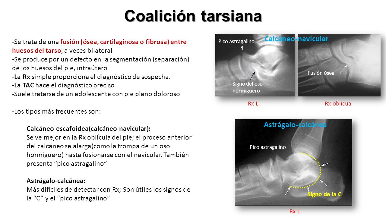 Coalición tarsiana -Se trata de una fusión (ósea, cartilaginosa o fibrosa) entre huesos del tarso, a veces bilateral -Se produce por un defecto en la segmentación (separación) de los huesos del pie, intraútero -La Rx simple proporciona el diagnóstico de sospecha.