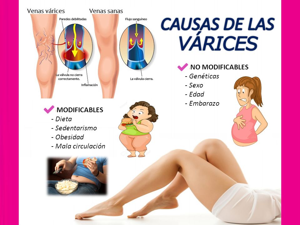 Obesidad y varices  ¿Cómo afecta el peso a las varices