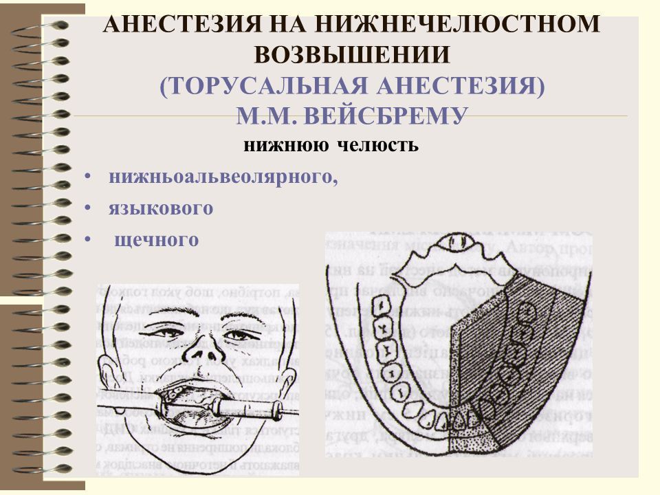 Крыловидно нижнечелюстная складка. Торусальная анестезия нижней челюсти. Торусальная анестезия зона обезболивания. Анестезия нижней челюсти зоны обезболивания. Методика проведения торусальной анестезии.