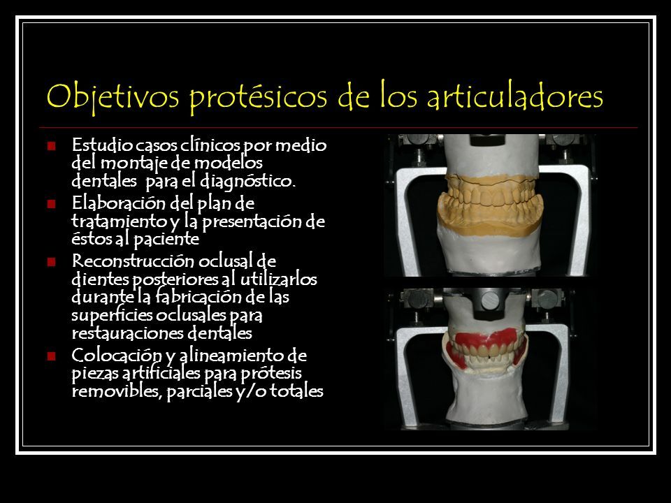 ARTICULADORES El articulador es un instrumento mecánico rígido,  representativo de las articulaciones temporomandibulares y componentes de  los maxilares, - ppt descargar