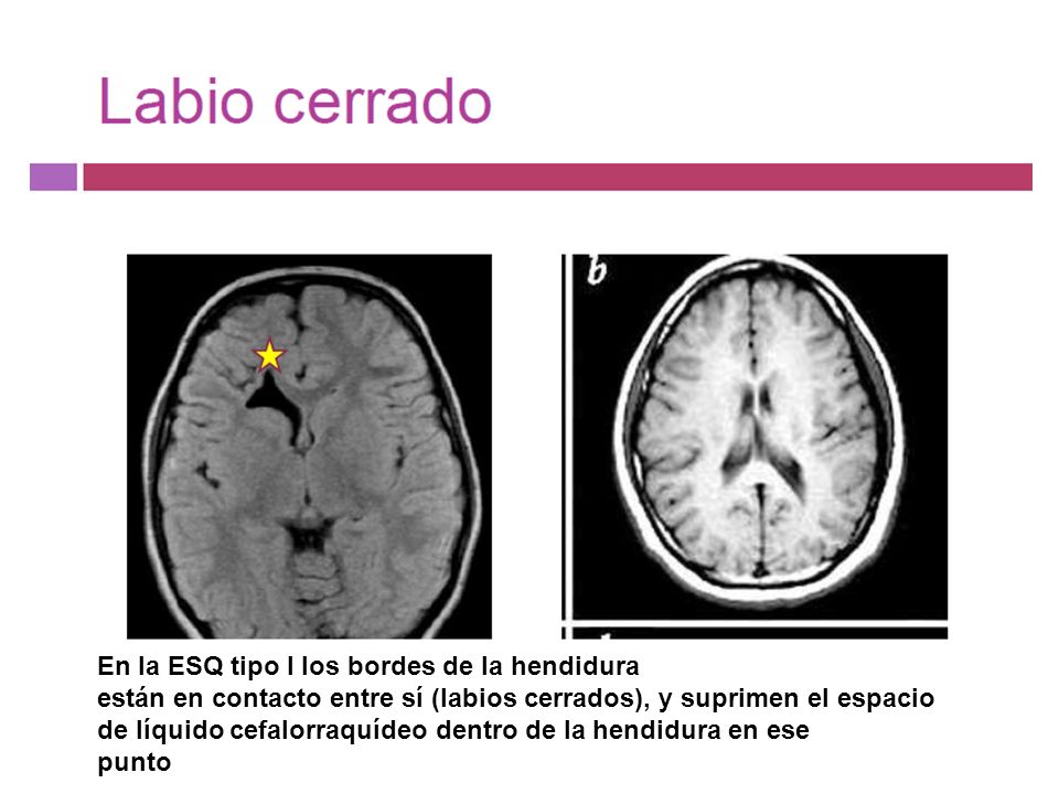 esquizencefalia de labios cerrados