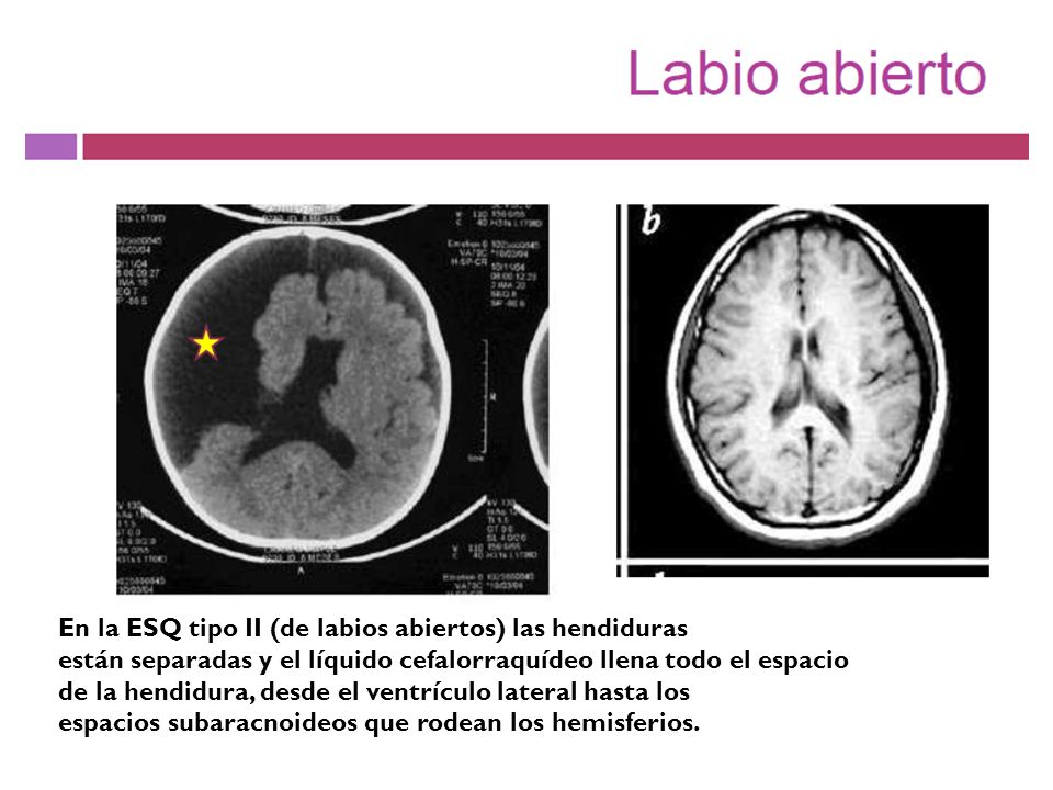 esquizencefalia de labios cerrados