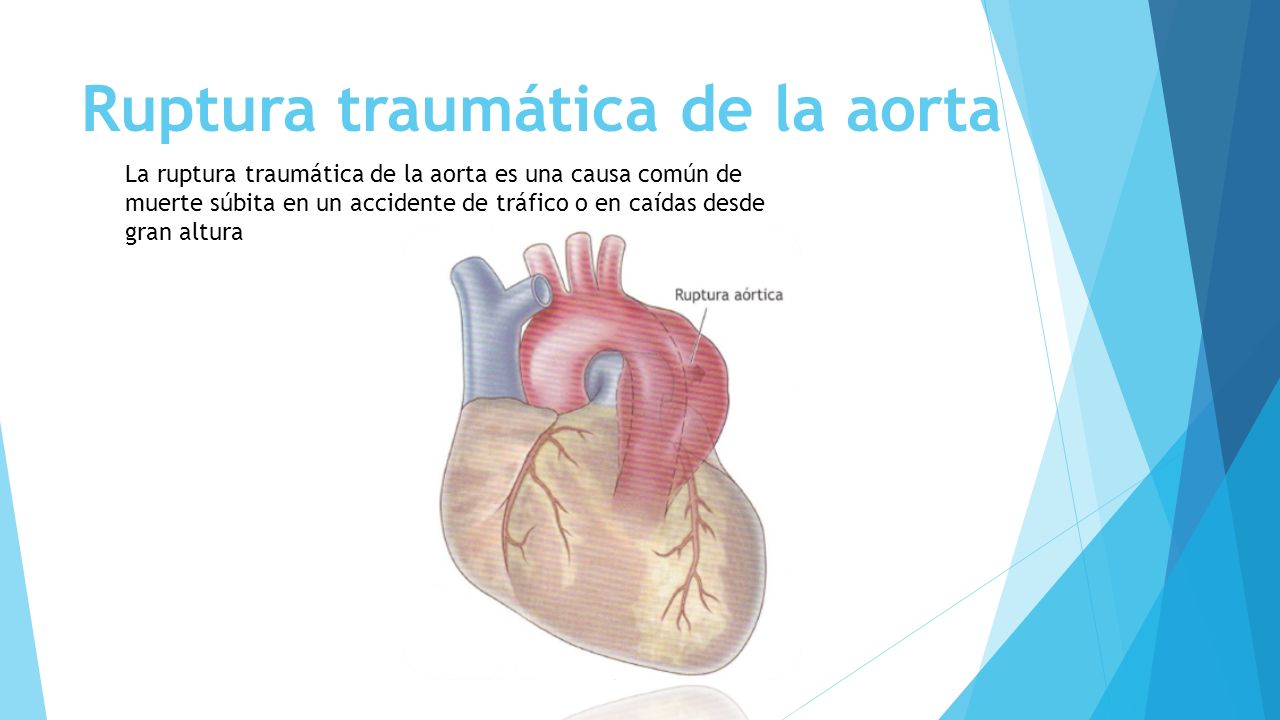 ruptura aórtica traumática