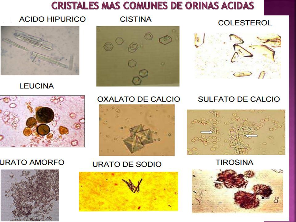 cristales de leucina en la orina