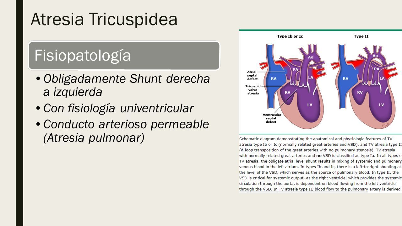 ATRESIA TRICUSPIDEA Y ATRESIA PULMONAR. Atresia tricuspidea Agenesia ...