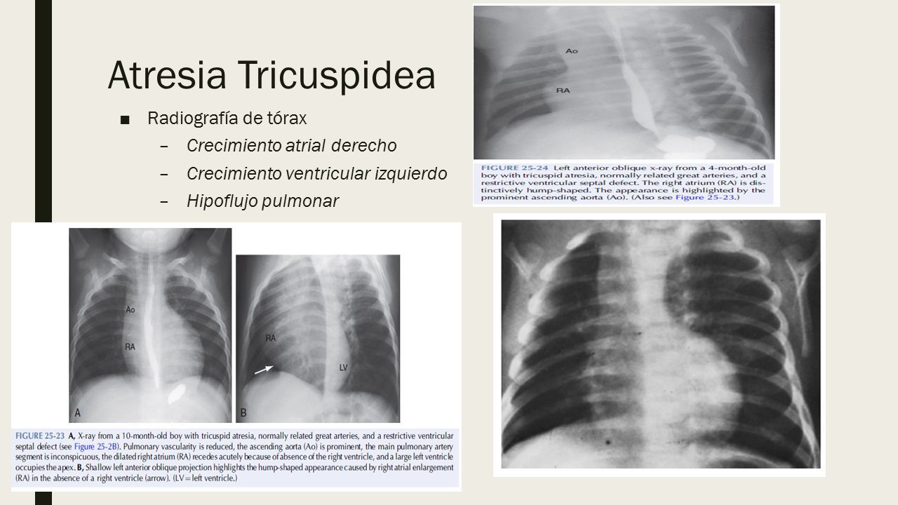 radiografía de atresia tricuspídea