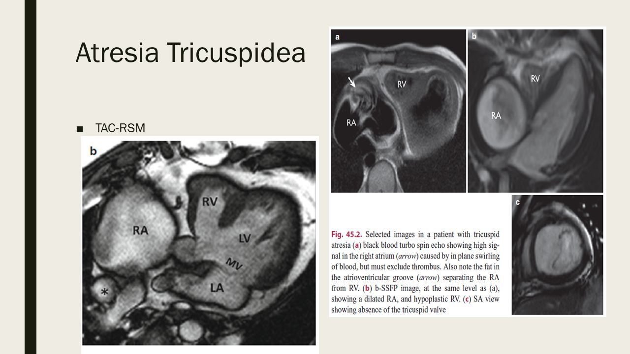 radiografía de atresia tricuspídea