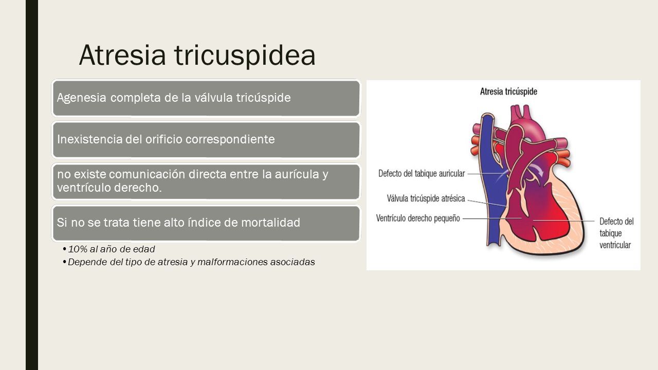 ATRESIA TRICUSPIDEA Y ATRESIA PULMONAR. Atresia tricuspidea Agenesia ...