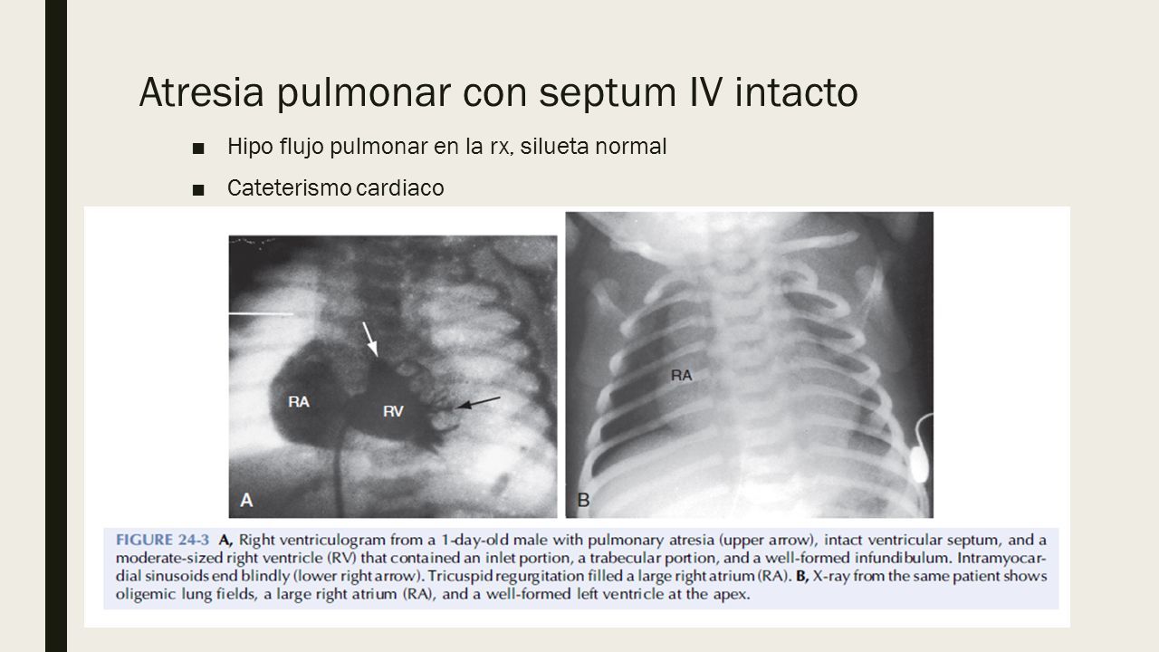 radiografia de atresia tricúspide