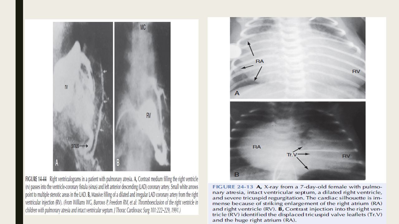 radiografía de atresia tricuspídea