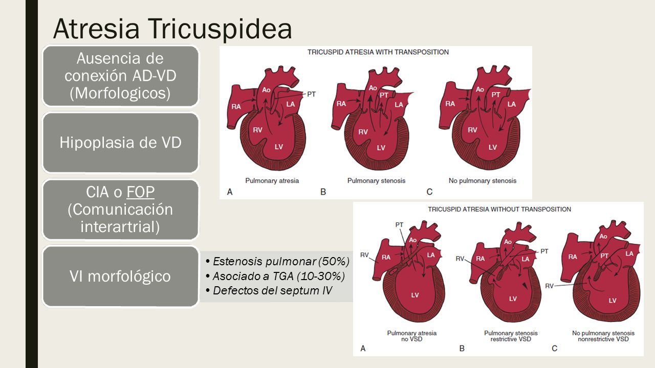 ATRESIA TRICUSPIDEA Y ATRESIA PULMONAR. Atresia tricuspidea Agenesia ...