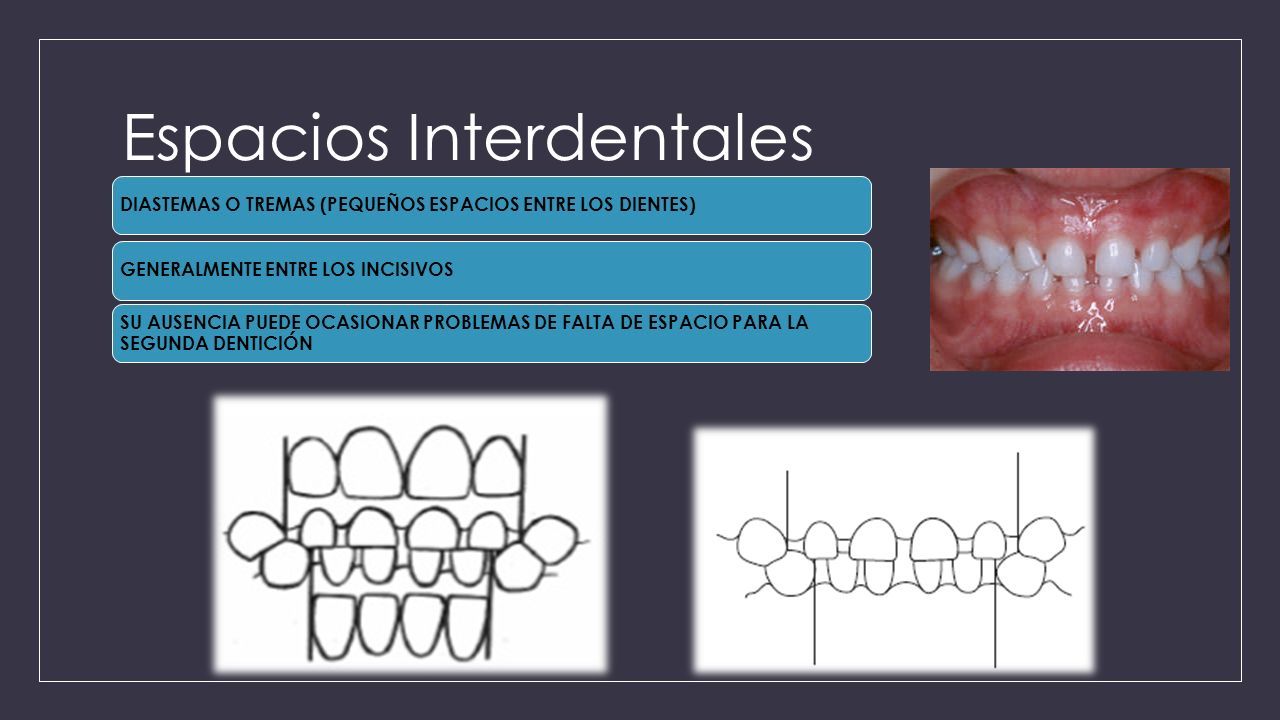 C DENTADURA INFANTIL ANATOMIA DENTAL. DENTADURA INFANTIL PRIMERA DENTICION  FUNDAMENTAL. - ppt descargar