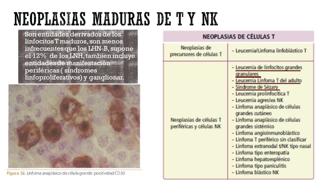Neoplasias de celulas b maduras