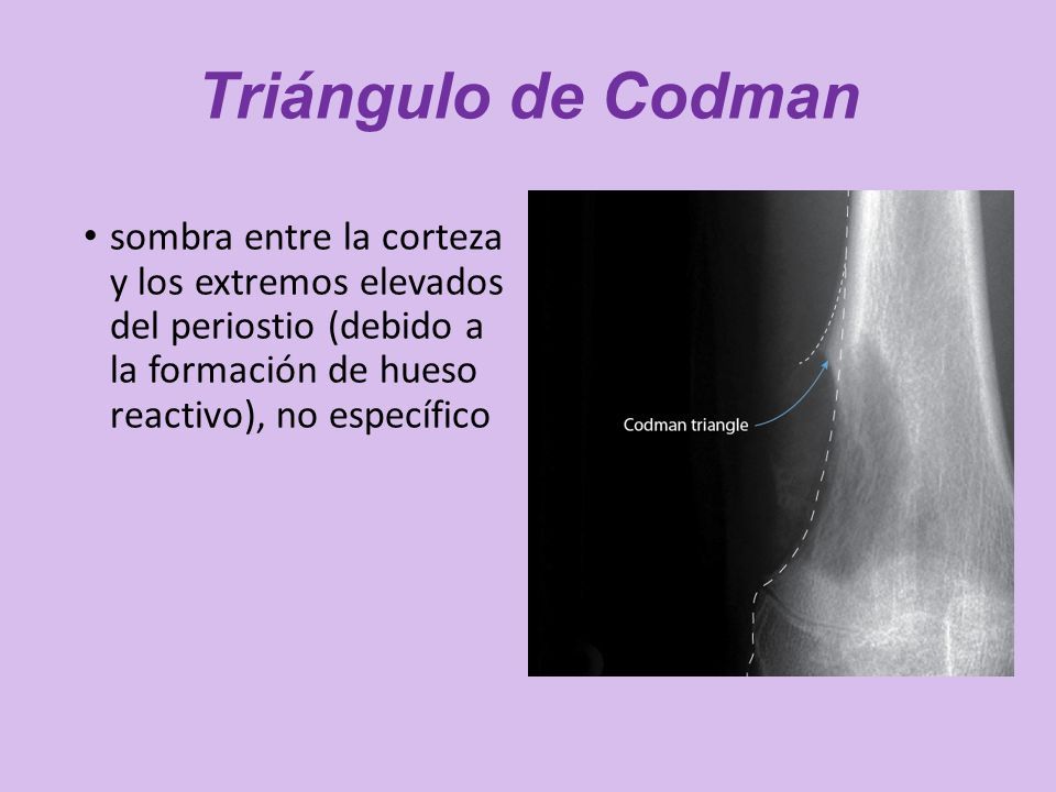 Triangulo De Codman