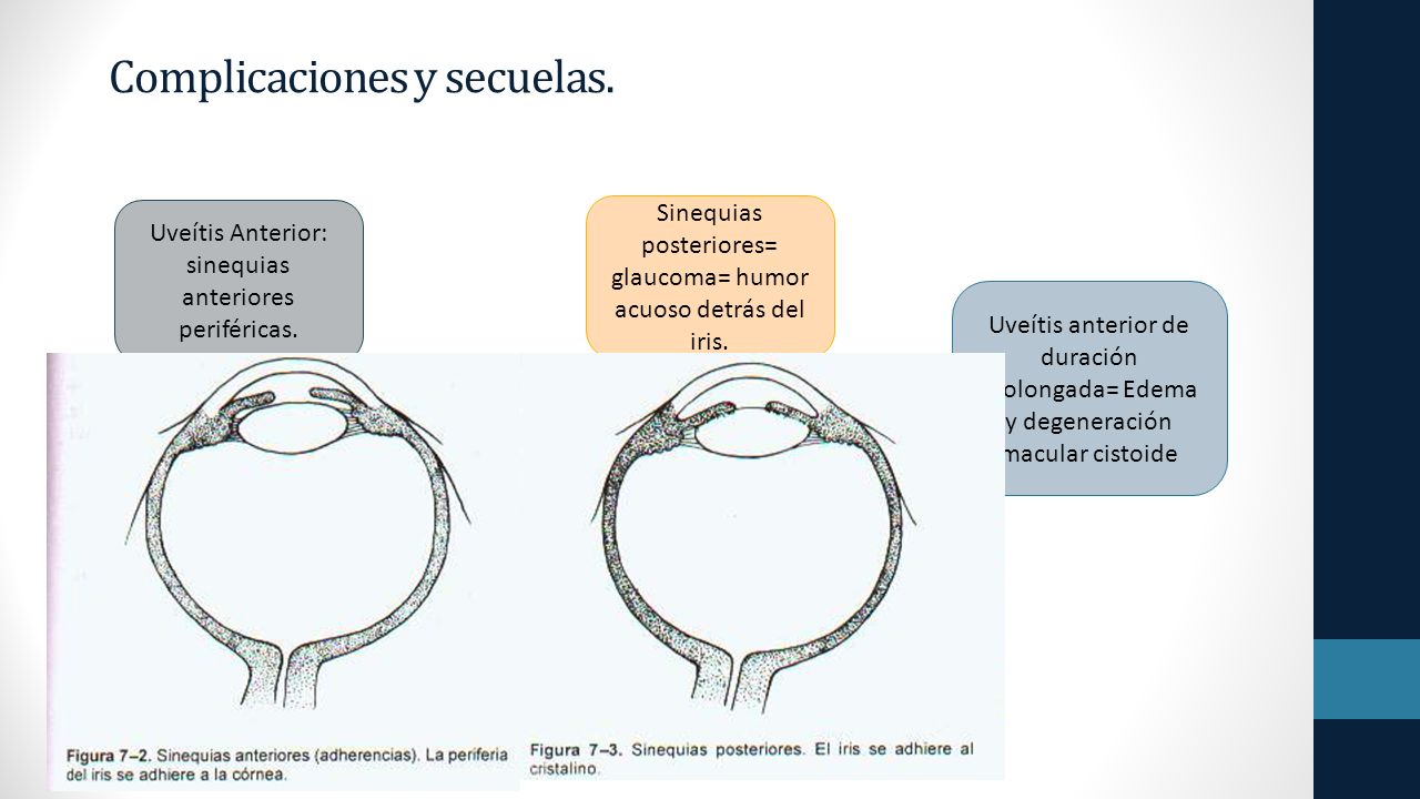 sinequias anteriores